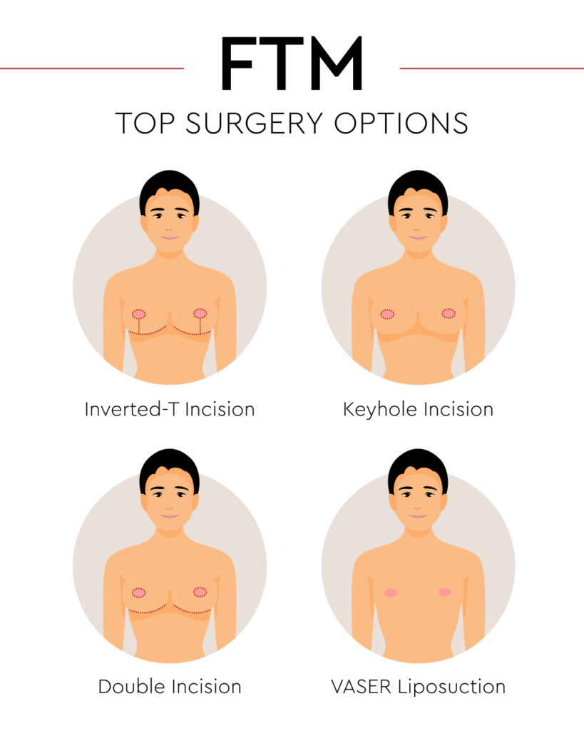 FTM top surgery options