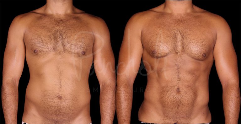 before and after vaser liposuction front view male patient case 1172