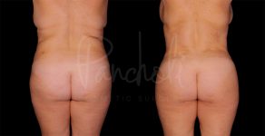 before and after liposuction female patient back view case 1495
