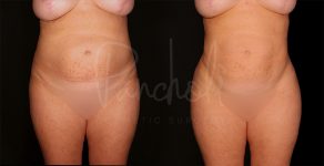 before and after liposuction female patient front view case 1495