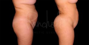 before and after liposuction female patient side view case 1495