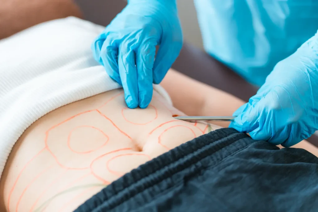 Healthcare provider marking abdomen before liposuction procedure